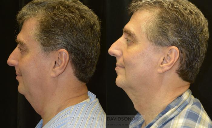 Kybella® for Double Chins Case 140 Before & After View #4 | Boston, MA | Christopher J. Davidson, MD