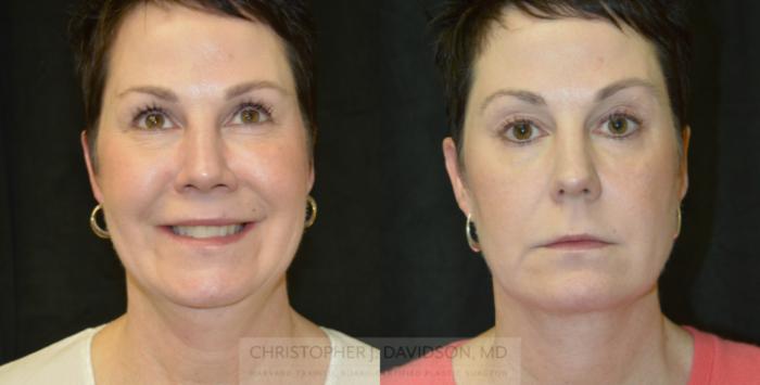 Kybella® for Double Chins Case 213 Before & After View #1 | Boston, MA | Christopher J. Davidson, MD