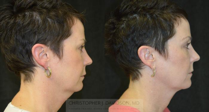Kybella® for Double Chins Case 213 Before & After View #3 | Boston, MA | Christopher J. Davidson, MD