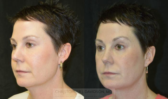 Kybella® for Double Chins Case 213 Before & After View #4 | Boston, MA | Christopher J. Davidson, MD