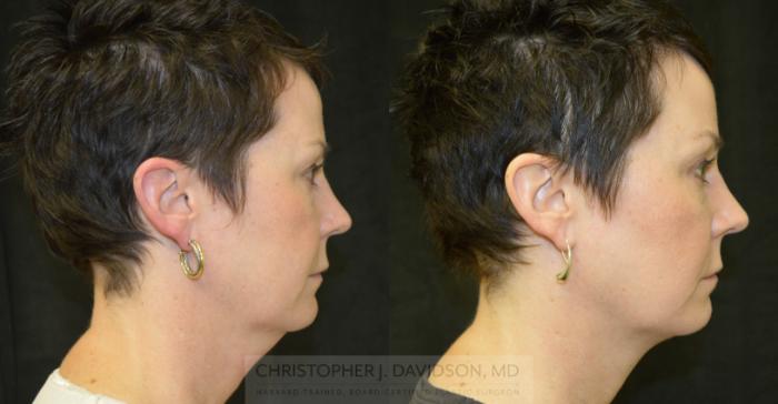 Kybella® for Double Chins Case 90 Before & After View #1 | Boston, MA | Christopher J. Davidson, MD