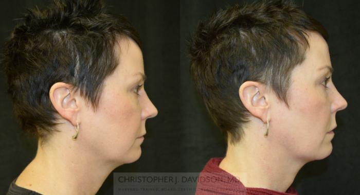 Kybella® for Double Chins Case 90 Before & After View #2 | Boston, MA | Christopher J. Davidson, MD