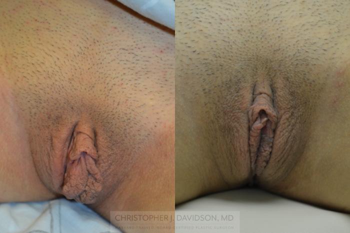 Labiaplasty Case 147 Before & After View #1 | Boston, MA | Christopher J. Davidson, MD
