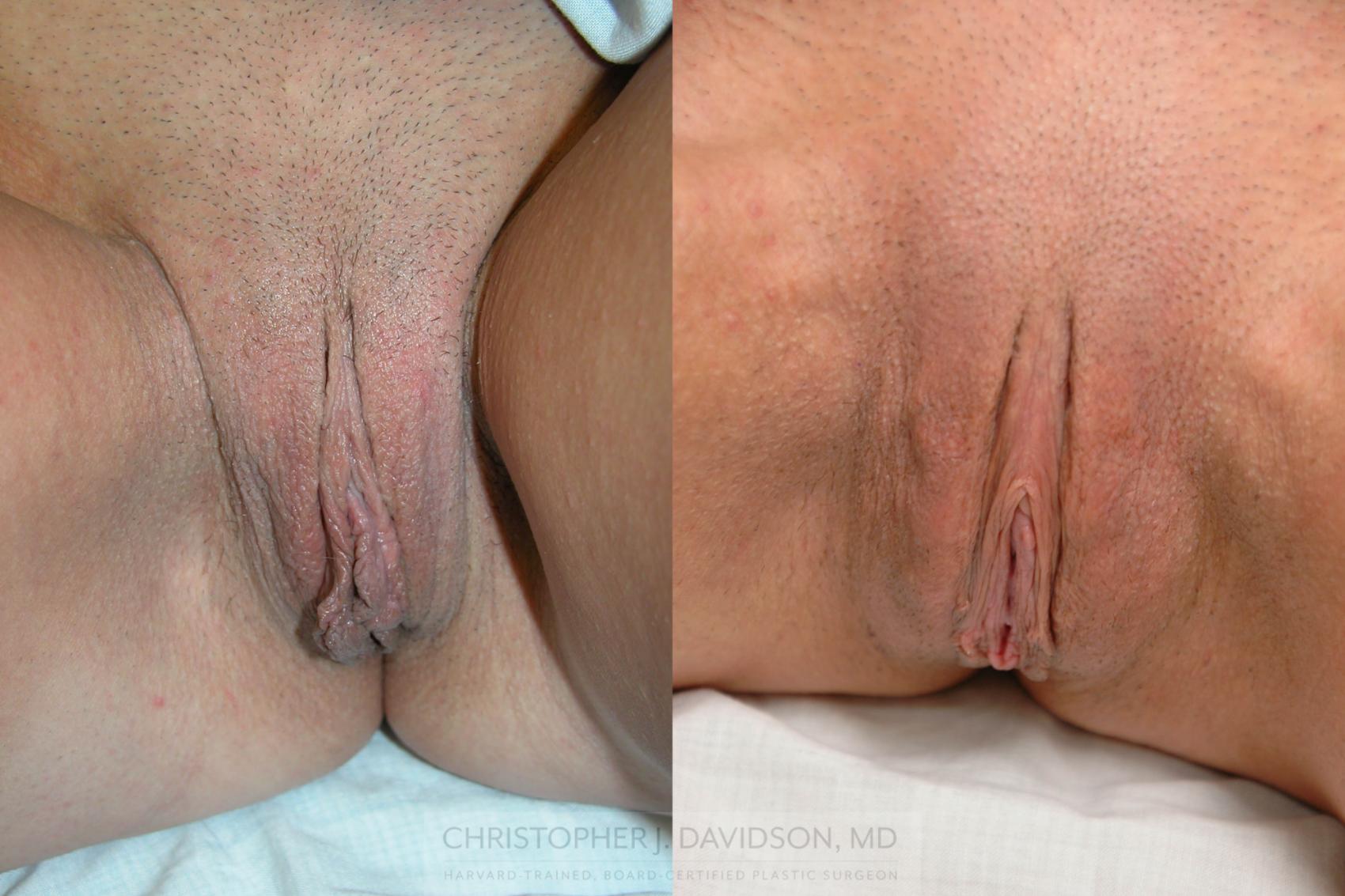 Labiaplasty Case 189 Before & After View #1 | Wellesley, MA | Christopher J. Davidson, MD