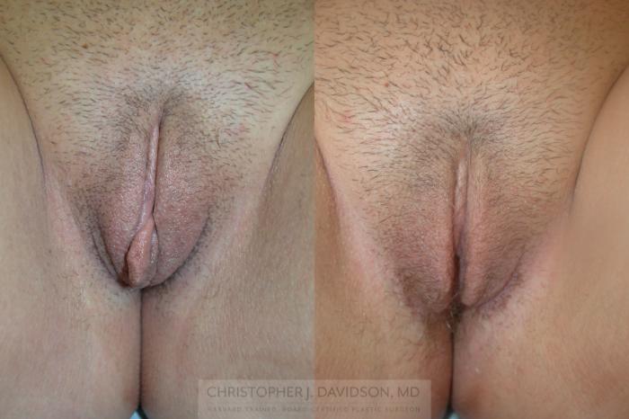 Labiaplasty Case 198 Before & After View #1 | Boston, MA | Christopher J. Davidson, MD