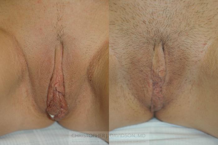 Labiaplasty Case 201 Before & After View #1 | Boston, MA | Christopher J. Davidson, MD