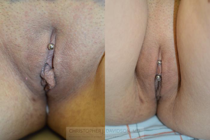 Labiaplasty Case 229 Before & After View #1 | Boston, MA | Christopher J. Davidson, MD