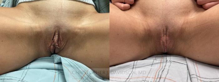 Labiaplasty Case 488 Before & After Left Side | Boston, MA | Christopher J. Davidson, MD