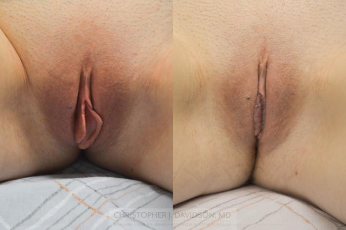 Labiaplasty Case 63 Before & After View #1 | Boston, MA | Christopher J. Davidson, MD