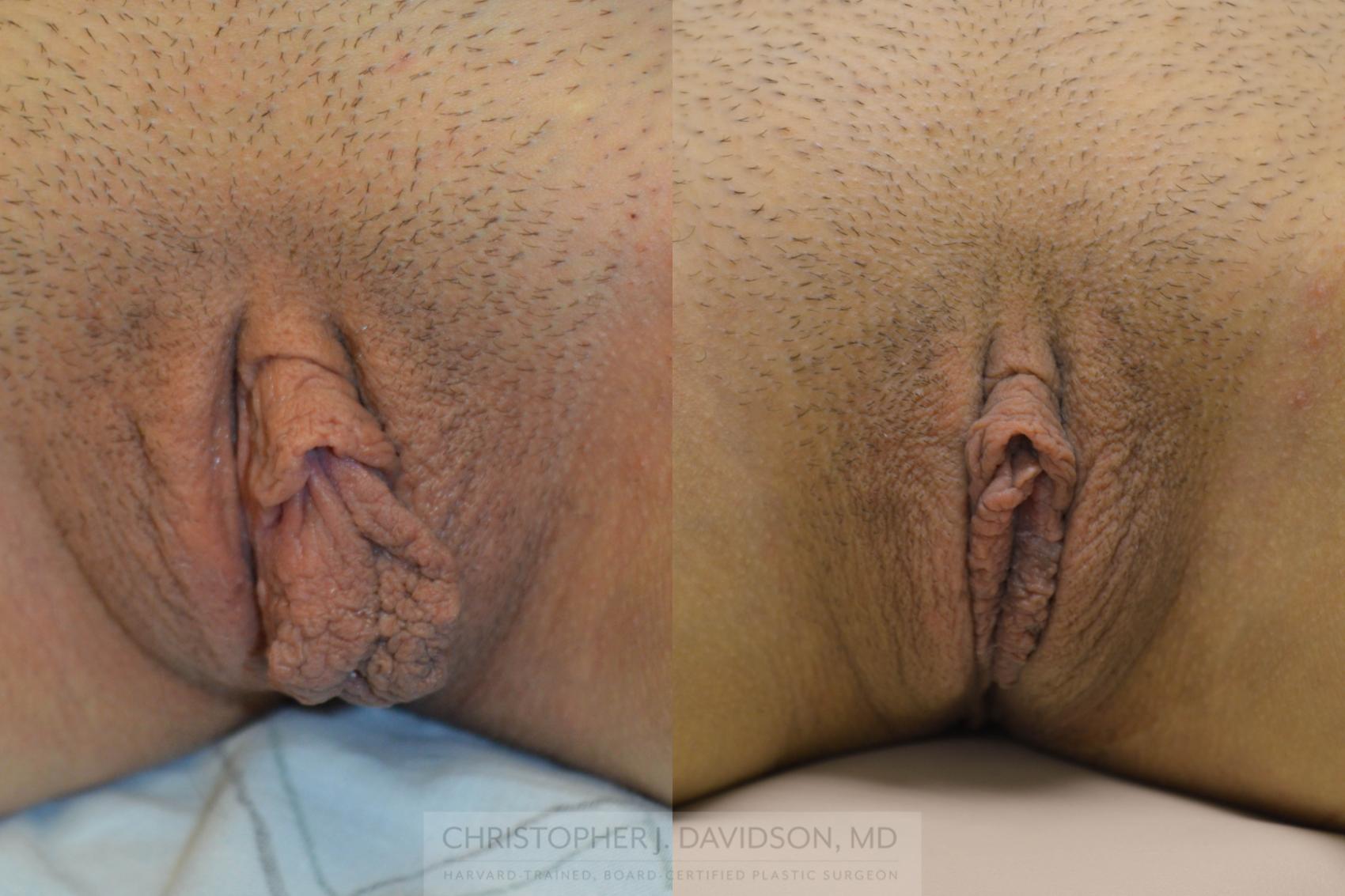 Labiaplasty Case 64 Before & After View #1 | Wellesley & Boston, MA | Christopher J. Davidson, MD