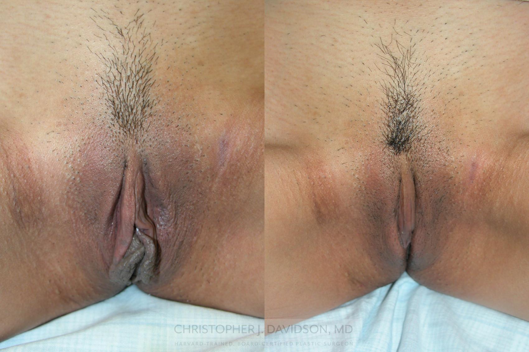 Labiaplasty Case 86 Before & After View #1 | Wellesley, MA | Christopher J. Davidson, MD
