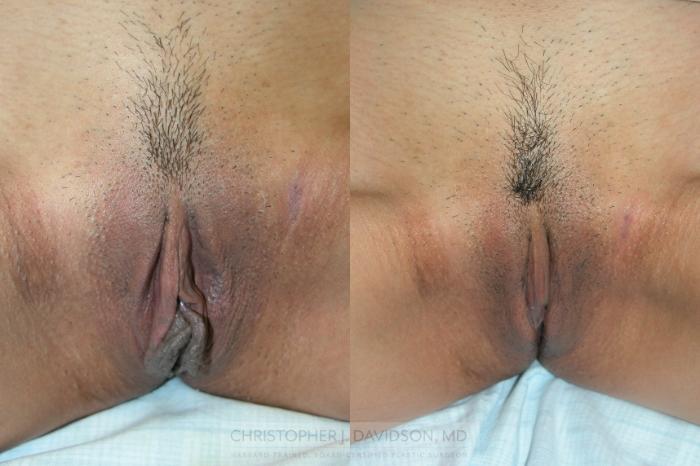Labiaplasty Case 86 Before & After View #1 | Boston, MA | Christopher J. Davidson, MD