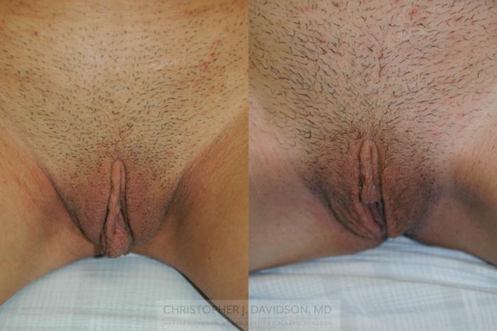 Labiaplasty Case 88 Before & After View #1 | Boston, MA | Christopher J. Davidson, MD
