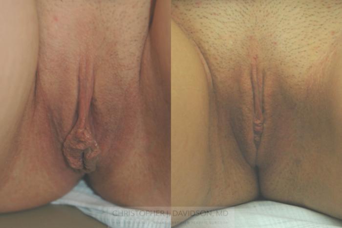 Labiaplasty Case 93 Before & After View #1 | Boston, MA | Christopher J. Davidson, MD