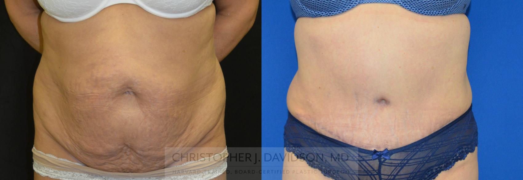 Liposuction Case 150 Before & After View #1 | Wellesley, MA | Christopher J. Davidson, MD