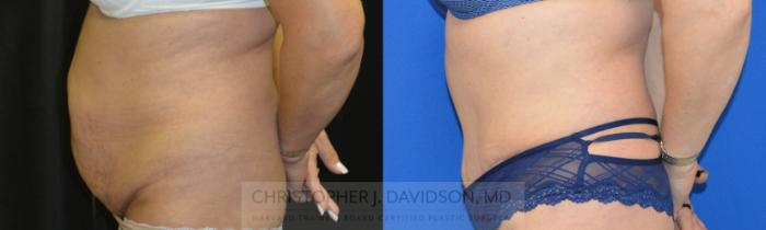 Liposuction Case 150 Before & After View #3 | Boston, MA | Christopher J. Davidson, MD
