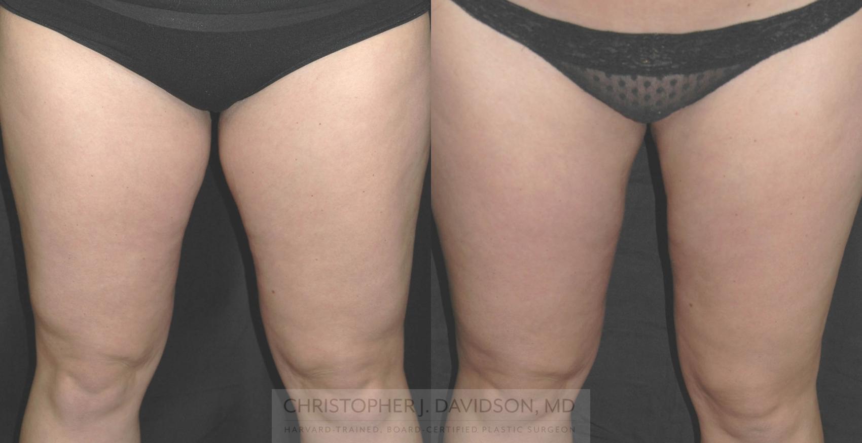 Liposuction Case 185 Before & After View #1 | Wellesley, MA | Christopher J. Davidson, MD
