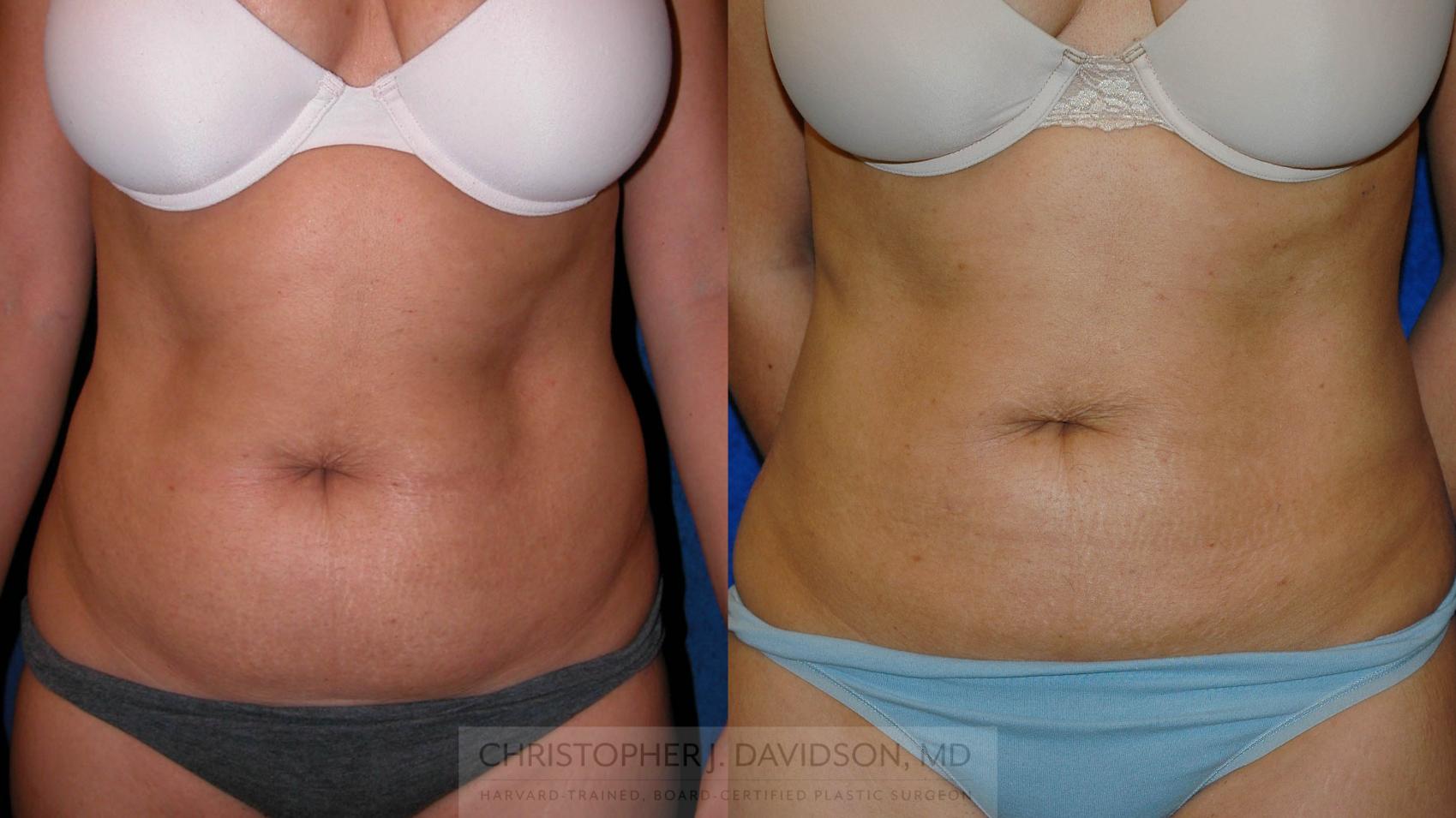 Liposuction Case 192 Before & After View #1 | Wellesley, MA | Christopher J. Davidson, MD