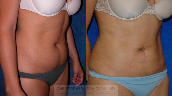 Liposuction Case 192 Before & After View #2 | Boston, MA | Christopher J. Davidson, MD