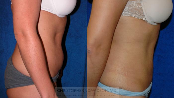 Liposuction Case 192 Before & After View #3 | Boston, MA | Christopher J. Davidson, MD