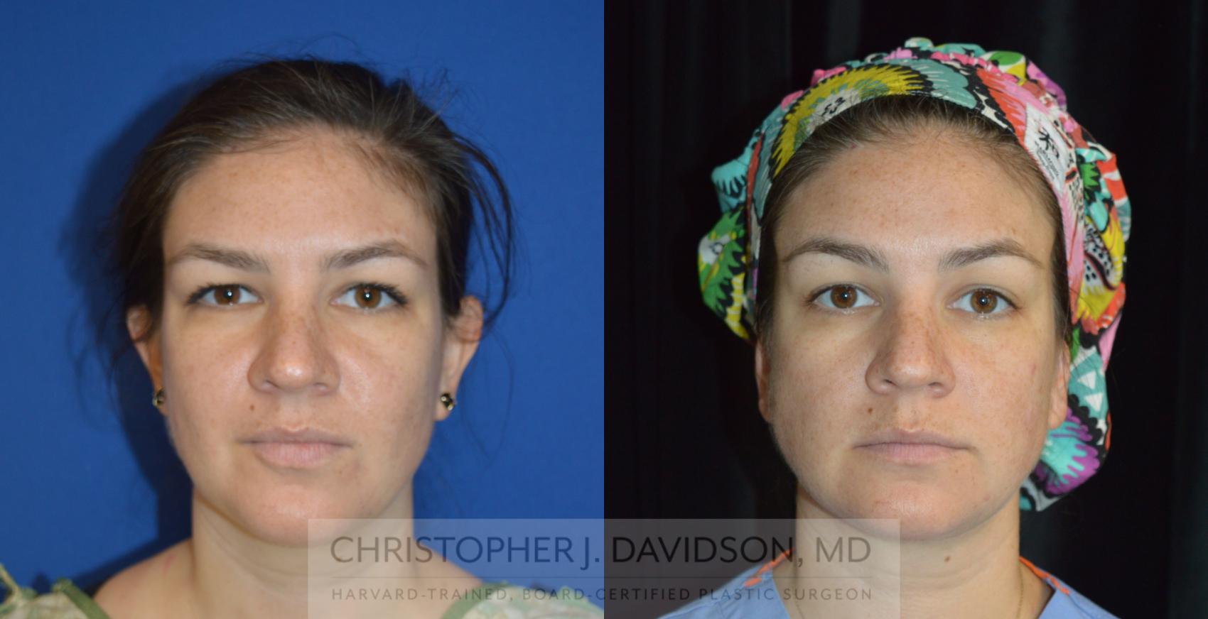 Liposuction Case 272 Before & After Front | Wellesley, MA | Christopher J. Davidson, MD