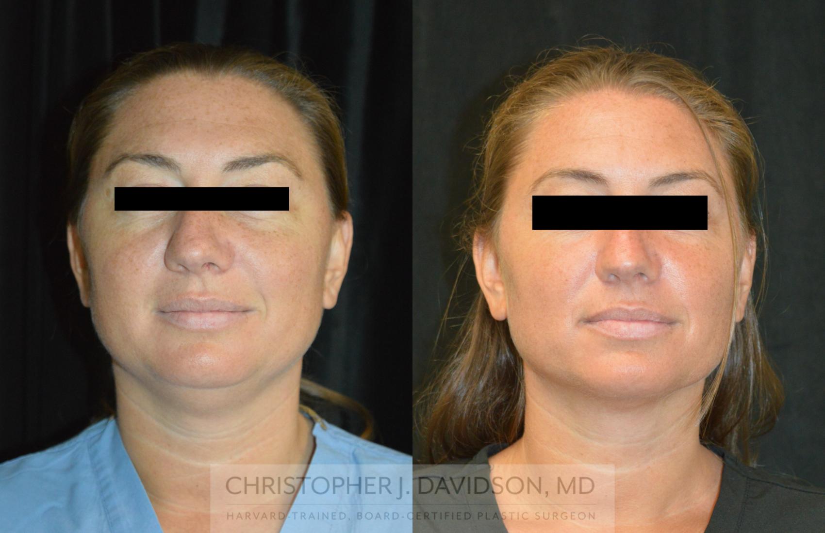 Liposuction Case 273 Before & After Front | Wellesley, MA | Christopher J. Davidson, MD