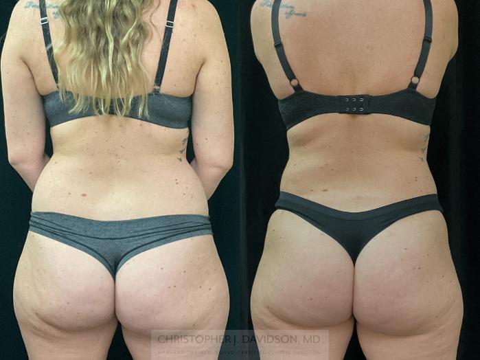 Liposuction Case 312 Before & After Back | Boston, MA | Christopher J. Davidson, MD