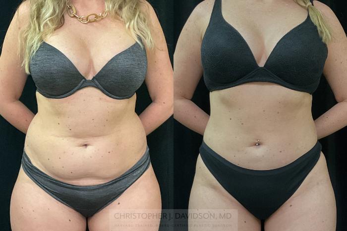 Liposuction Case 312 Before & After Front | Boston, MA | Christopher J. Davidson, MD