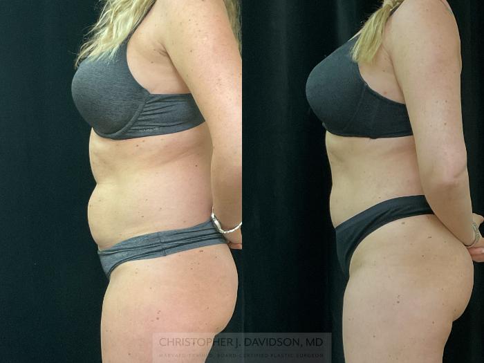 Liposuction Case 312 Before & After Left Side | Boston, MA | Christopher J. Davidson, MD