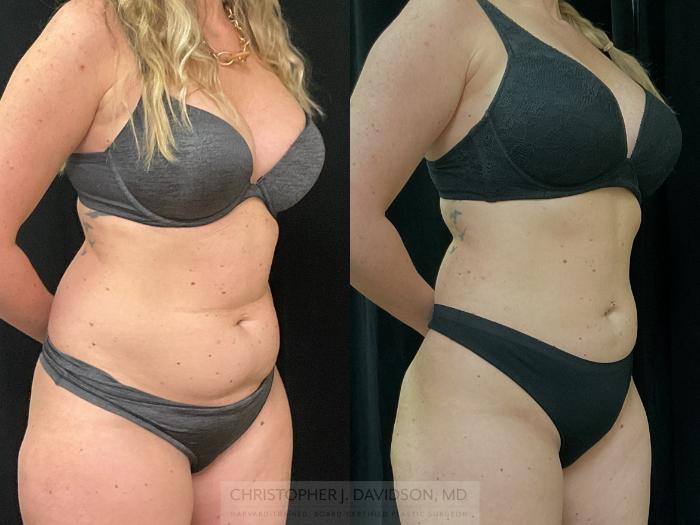 Liposuction Case 312 Before & After Right Oblique | Boston, MA | Christopher J. Davidson, MD