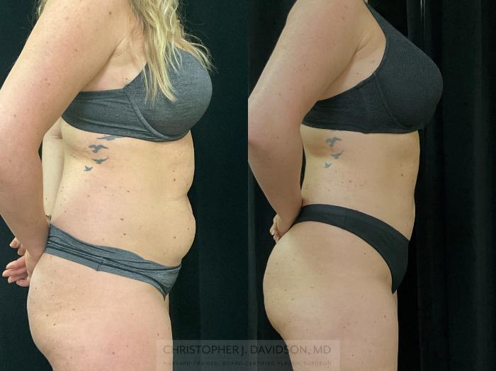 Liposuction Case 312 Before & After Right Side | Boston, MA | Christopher J. Davidson, MD