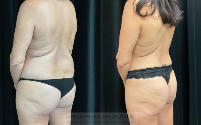 Liposuction Case 325 Before & After Back - Left Oblique | Boston, MA | Christopher J. Davidson, MD