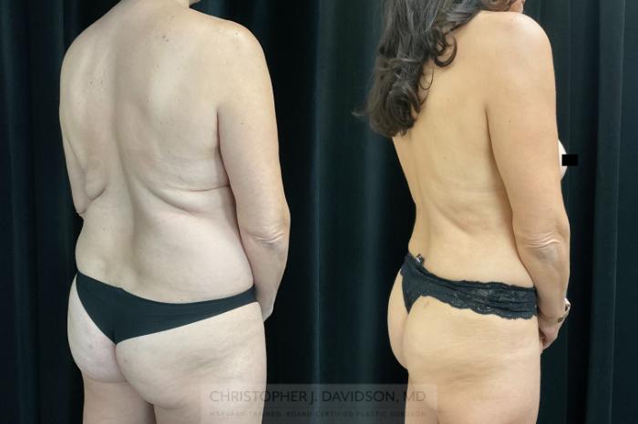 Liposuction Case 325 Before & After Back - Right Oblique | Boston, MA | Christopher J. Davidson, MD