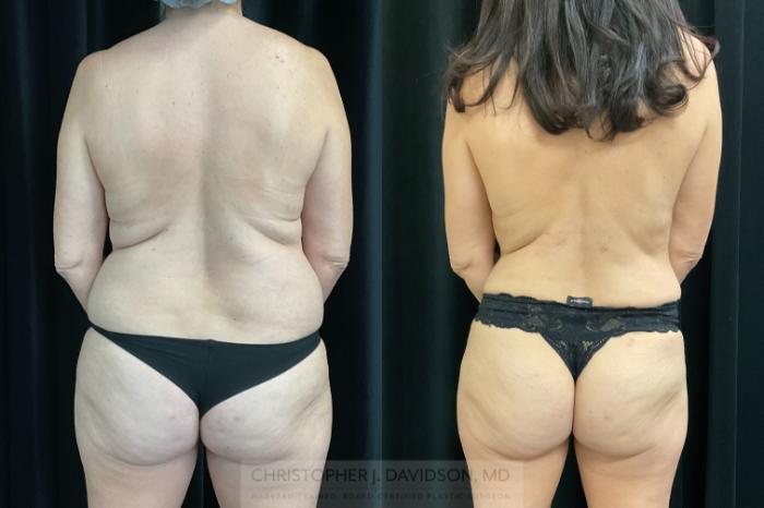 Liposuction Case 325 Before & After Back | Boston, MA | Christopher J. Davidson, MD