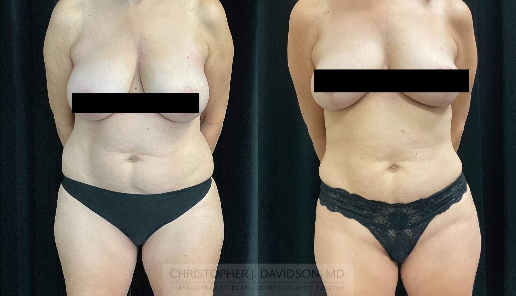 Liposuction Case 325 Before & After Front | Boston, MA | Christopher J. Davidson, MD