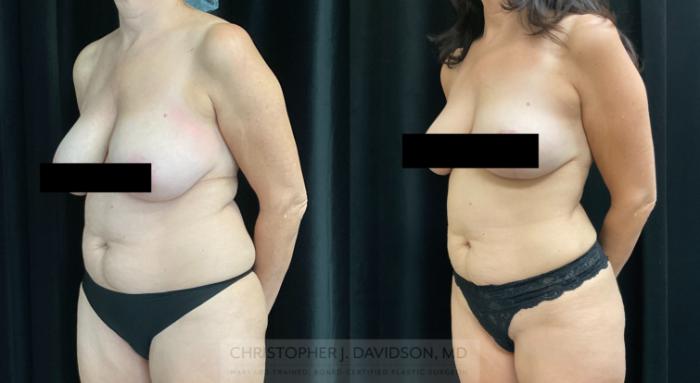 Liposuction Case 325 Before & After Left Oblique | Boston, MA | Christopher J. Davidson, MD