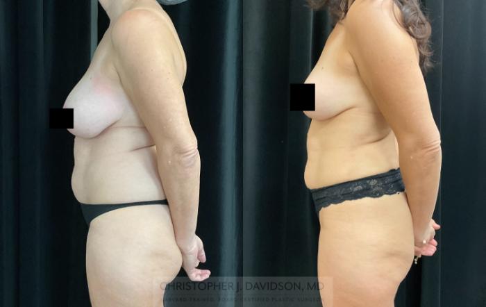 Liposuction Case 325 Before & After Left Side | Boston, MA | Christopher J. Davidson, MD