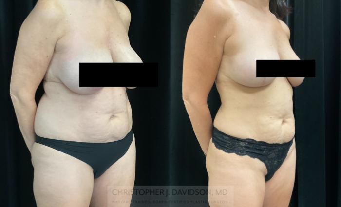 Liposuction Case 325 Before & After Right Oblique | Boston, MA | Christopher J. Davidson, MD