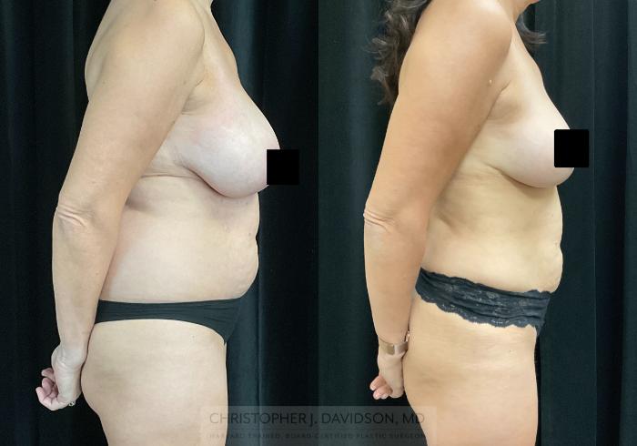 Liposuction Case 325 Before & After Right Side | Boston, MA | Christopher J. Davidson, MD