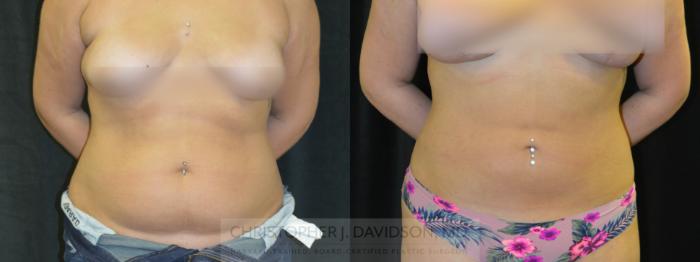 Liposuction Case 399 Before & After Front | Boston, MA | Christopher J. Davidson, MD