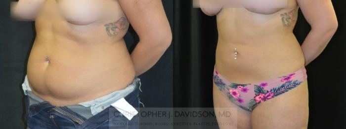 Liposuction Case 399 Before & After Left Oblique | Boston, MA | Christopher J. Davidson, MD