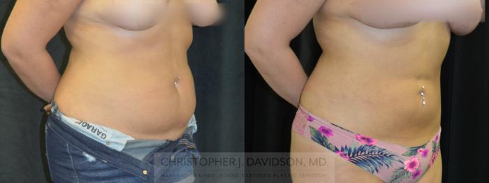 Liposuction Case 399 Before & After Right Oblique | Boston, MA | Christopher J. Davidson, MD