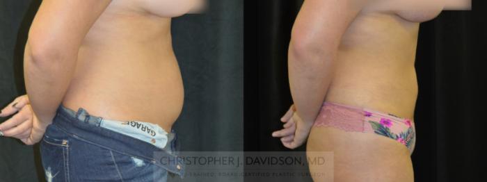 Liposuction Case 399 Before & After Right Side | Boston, MA | Christopher J. Davidson, MD