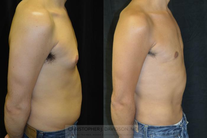 Liposuction Case 71 Before & After View #1 | Boston, MA | Christopher J. Davidson, MD