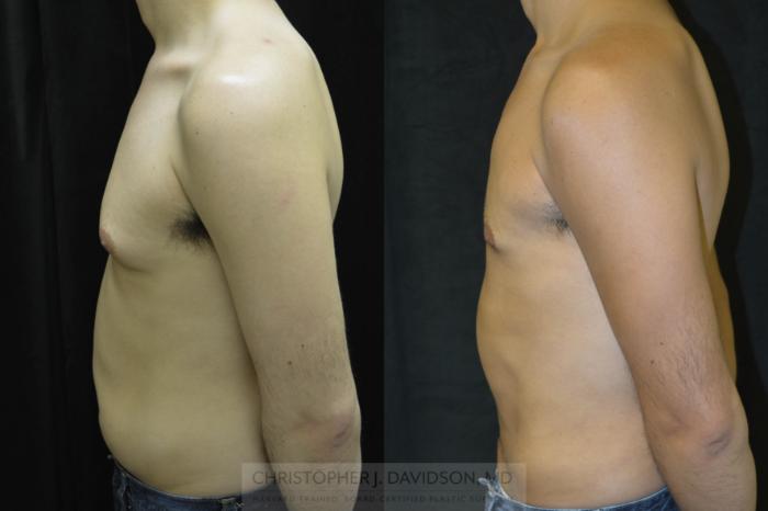 Liposuction Case 71 Before & After View #2 | Boston, MA | Christopher J. Davidson, MD