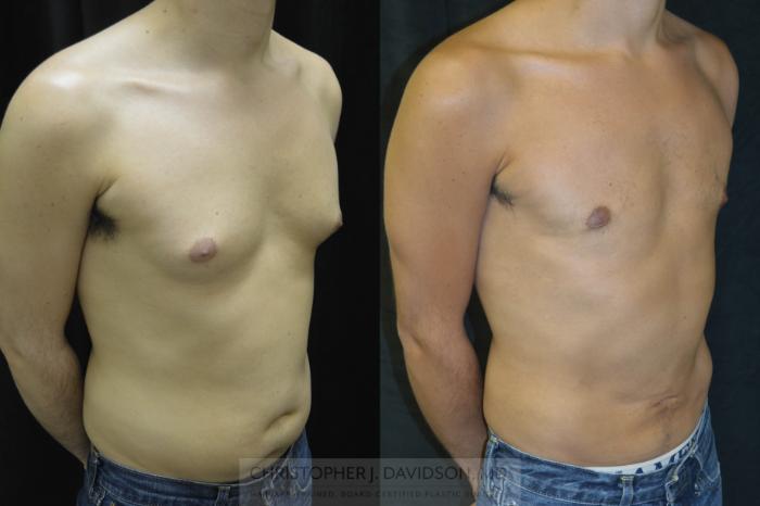 Liposuction Case 71 Before & After View #3 | Boston, MA | Christopher J. Davidson, MD