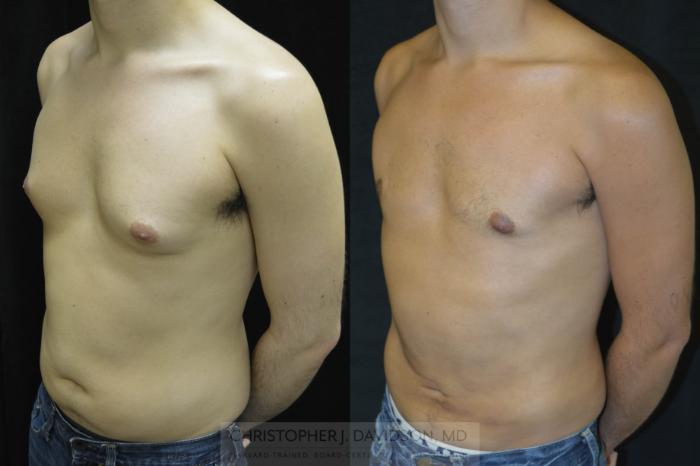 Liposuction Case 71 Before & After View #4 | Boston, MA | Christopher J. Davidson, MD