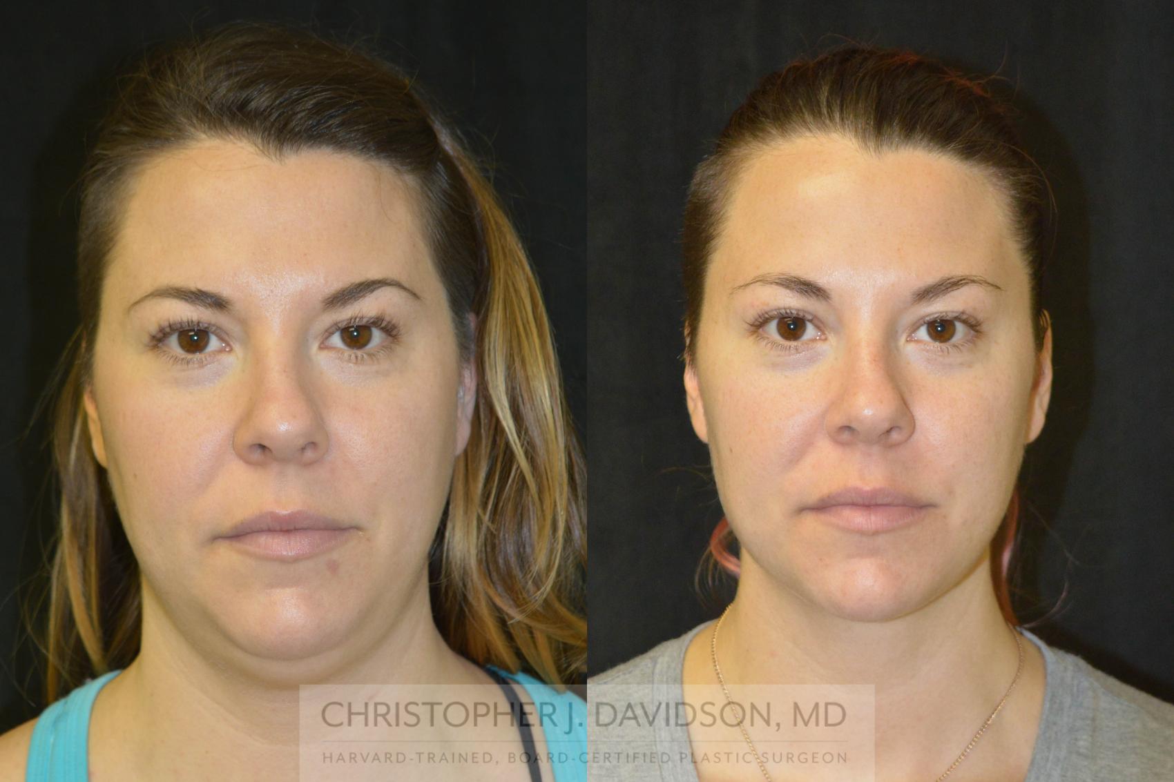 Liposuction Case 97 Before & After View #1 | Wellesley & Boston, MA | Christopher J. Davidson, MD