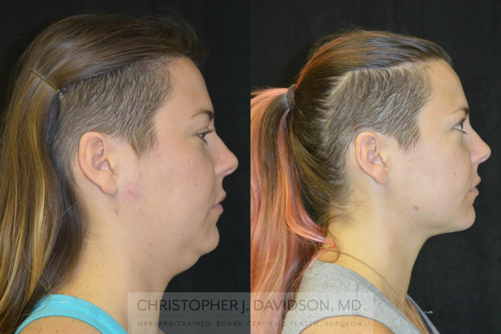 Liposuction Case 97 Before & After View #2 | Wellesley, MA | Christopher J. Davidson, MD