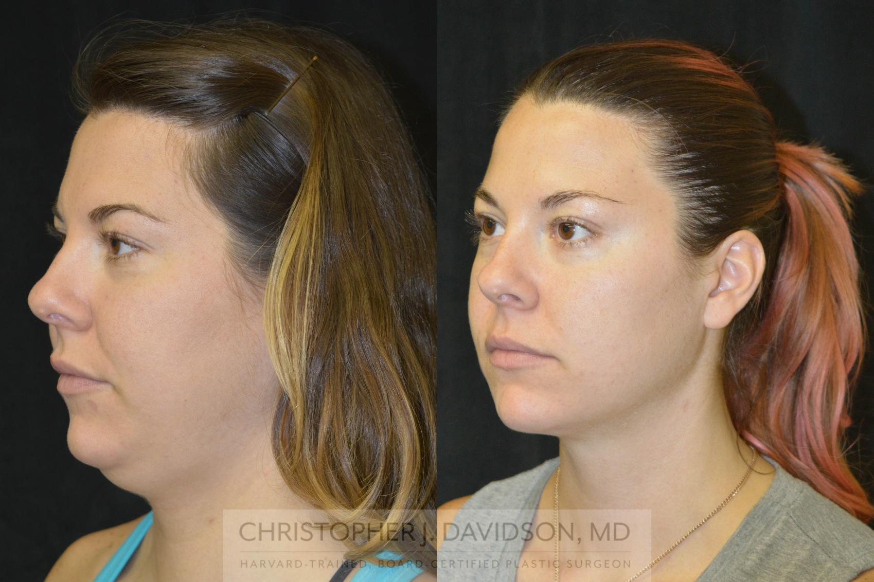 Liposuction Case 97 Before & After View #3 | Wellesley, MA | Christopher J. Davidson, MD